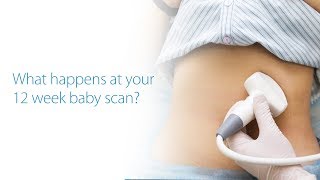 What to Expect At Your 12 Week Baby Scan Dublin Ireland [upl. by Platus]