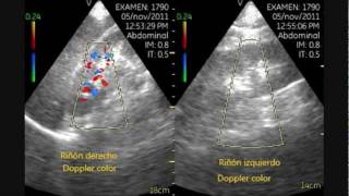 VSCAN Left renal infarction Pocket ultrasound bedside [upl. by Laflam308]