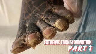 EXTREME FOOT TRANSFORMATION  PART 1 [upl. by Ynnatirb]