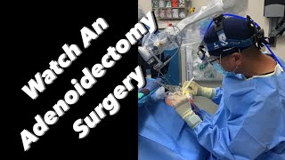 Adenoidectomy  actual footage [upl. by Wolfe]