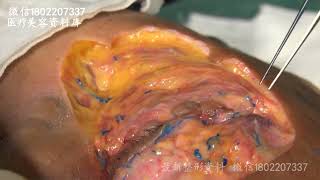 （8）面中部肌肉和眶下血管神经束解剖 8 Anatomy of midface muscles and infraorbital vascular nerve bundle [upl. by Dutch718]