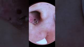 Ear Pimple and Blackhead Extraction Cleaning Out Your Ears [upl. by Stafford]