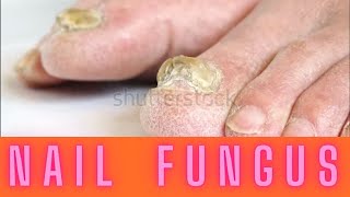 NAIL FUNGUS [upl. by Isabel]