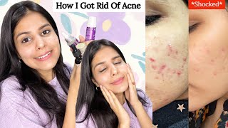 How I Got Rid Of My Acne  6 Products That Changed My Skin [upl. by Mcclish]