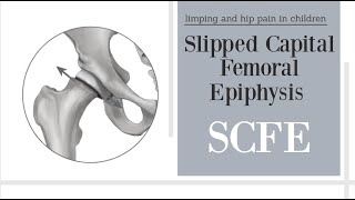 Slipped Capital Femoral Epiphysis SCFE [upl. by Krutz]