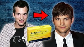 Ashton Kutcher Used Dutasteride For 10 Years To Keep His Hair [upl. by Nylrehs]