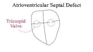 atrioventricular septal defect  avsd symptoms pathophysiology and complications  avsd repair [upl. by Atekahs684]