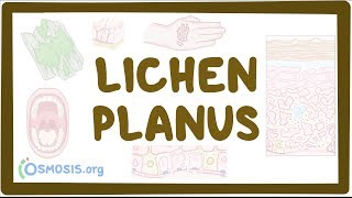 Lichen planus  causes symptoms diagnosis treatment pathology [upl. by Lyrad830]