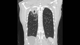 Chronic pulmonary aspergillosis after pulmonary tuberculosis [upl. by Art]