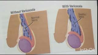 ReproductionDiseases of the Testes [upl. by Labina]