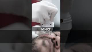 Micro needling Treatment For Acne Scars MNRFFlawlessSkin [upl. by Astred505]