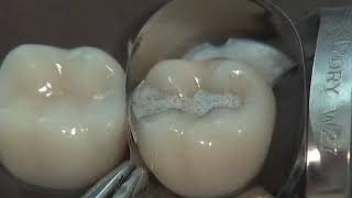 Class II Amalgam Preparation amp Restoration  Operative Dentistry [upl. by Atiuqcaj]