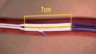 The VNUS Closure Procedure Using ClosureFAST Catheter [upl. by Tugman768]