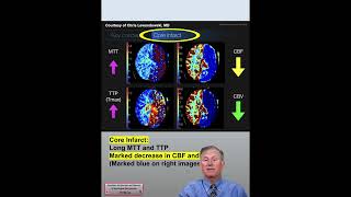 CT Perfusion Core Infarct amp Ischemic Penumbra Findings CTA amp CTP Neuroimaging in Stroke Patients 26 [upl. by Siurtemed]