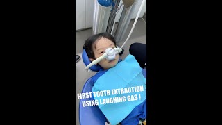 4 Year Old Toddler first tooth extraction  Kids Dental  Laughing Gas sedation  Tooth inflammation [upl. by Atiraj673]