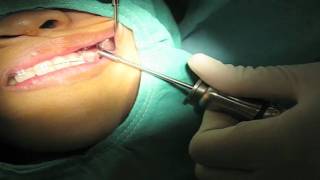 Orthodontic Bone Screw placement upper left buccal side [upl. by Derry845]