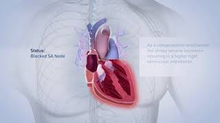 Biotronik pacemaker [upl. by Sucramej474]