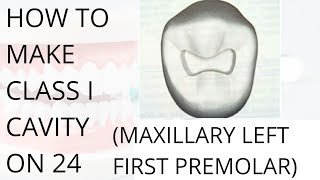 Class 1 Cavity Preparation on 24 Maxillary Left First Premolar  Butterfly Shaped Cavity [upl. by Enamrej754]