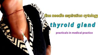 FNAC in the Diagnosis of Thyroid Gland [upl. by Durrace]