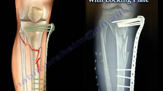 External Fixation With Locking Plate  Everything You Need To Know  Dr Nabil Ebraheim [upl. by Anaynek]