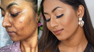 HOW TO COVER ACNE PRONE SKIN amp HYPERPIGMENTATION ✨  Flawless Full Coverage Base [upl. by Almat900]