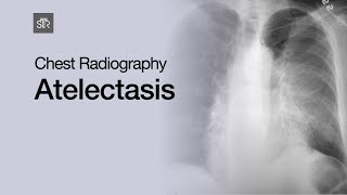 How to Interpret a Chest XRay Lesson 5  Cardiac Silhouette and Mediastinum [upl. by Costin84]