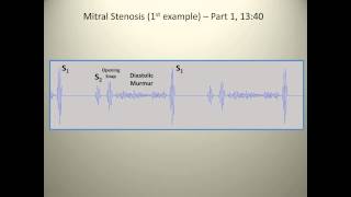 Examples of mitral stenosis murmurs [upl. by Eresed]