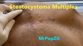 Steatocystoma Multiplex Dozens of extractions on the chest Chronic condition MrPopZit [upl. by Lamrouex]