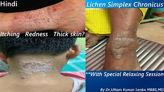 Lichen Simplex Chronicus  Treatment of thickened itchy skindry eczema treatment Dr Uttam Lenka [upl. by Pavel]