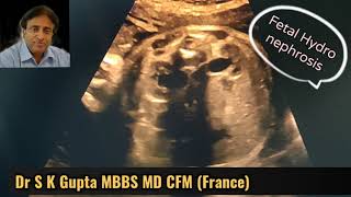 Fetal Hydronephrosis Renal Pyelectasis गर्भ शिशु के गुर्दे मैं सूजन क्यो होती है क्या इलाज [upl. by Renate]