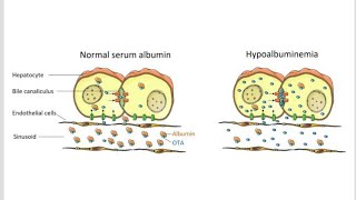 Causes or factors of Hypoalbuminemia [upl. by Eetse330]