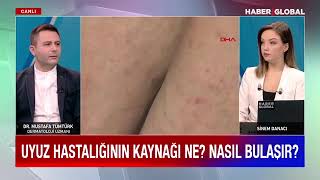 Uyuz Hastalığı nedir Belirtileri nelerdir Nasıl geçer Dermatolog Dr Mustafa Tümtürk haberglobal [upl. by Anida]