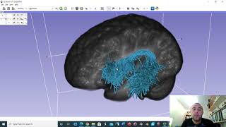 The anatomy of the arcuate fasciculus using diffusion MRI data [upl. by Sterne]