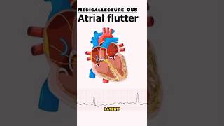 Attrial flutter  Arrhythmia  viral shorts heart [upl. by Elvin]