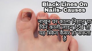 नाखुन पर दिखे ब्लैक लाइन तो ये हो सकता है इस बड़ी बीमारी का संकेत black toenail treatment at home [upl. by Nywde]