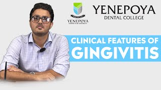 Clinical Features of Gingivitis  Periodontology  Yenepoya Dental College [upl. by Ahseirej]