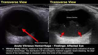 Eye Ultrasound Reporting  Cataract Retinal Detachments Vitreous Hemorrhage USG Case Reports [upl. by Reagen111]