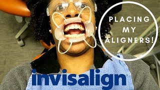 INVISALIGN Update Pt 3  Placing My BUTTONS and ALIGNERS [upl. by Maddy]