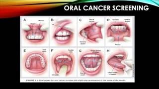 Parkland Dental Hygiene  Identifying Normal Oral Structures Cancers and Suspicious Lesions [upl. by Ris]