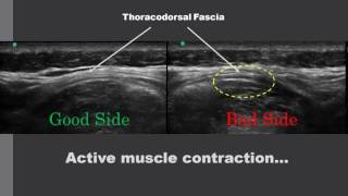 Thoracodorsal fascia ultrasound imaging [upl. by Ainirtak]