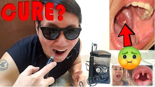 Removing Tonsil Stones At Home  Compilation [upl. by Bing]