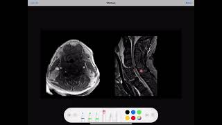 LEFT VERTEBRAL ARTERY DISSECTION [upl. by Diella]