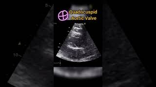 Quadricuspid aortic valve QAV Echocardiography anatomy [upl. by Elehcir412]