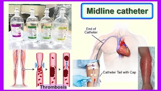 midline catheter [upl. by Langbehn273]