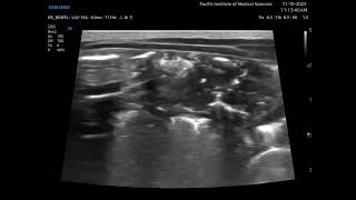 Necrotizing enterocolitis NEC [upl. by Enitnatsnoc]