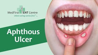 Aphthous Ulcer Treatment Stop Oral Sores Fast  Dr Major Rajesh Bhardwaj entsurgeon [upl. by Freberg603]