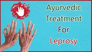 How to cure Leprosy With Ayurveda Symptoms Causes amp Ayurvedic Treatment For Leprosy [upl. by Sivar]