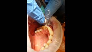 How To Needlefree dental injection by Dr Roslyn Skinner [upl. by Nachison]