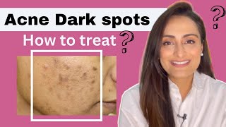 Acne Dark Spots  हिंदी  How to treat  serum cream recommendations  Dermatologist  Dr Aanchal [upl. by Gladine]