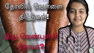 தோலில் வெள்ளை திட்டுகள்  ஏன் ஏற்படுகிறது காரணம் என்ன   EXPLAINED in Tamil [upl. by Preuss870]